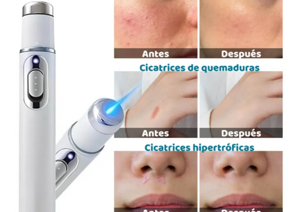 Pluma Laser Luz Azul Cuidado Facial Anti Acné Y Cicatrices