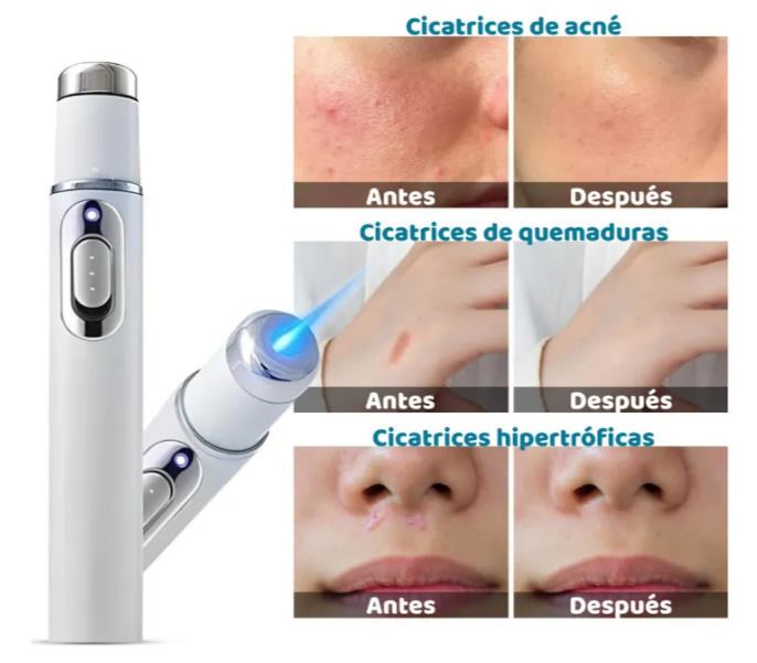 Pluma Laser Luz Azul Cuidado Facial Anti Acné Y Cicatrices